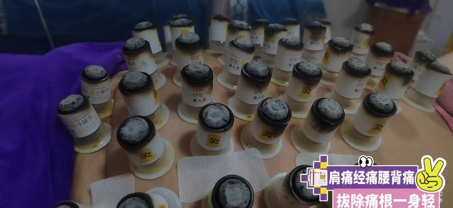 Close-up of therapeutic cups placed on a guest's back