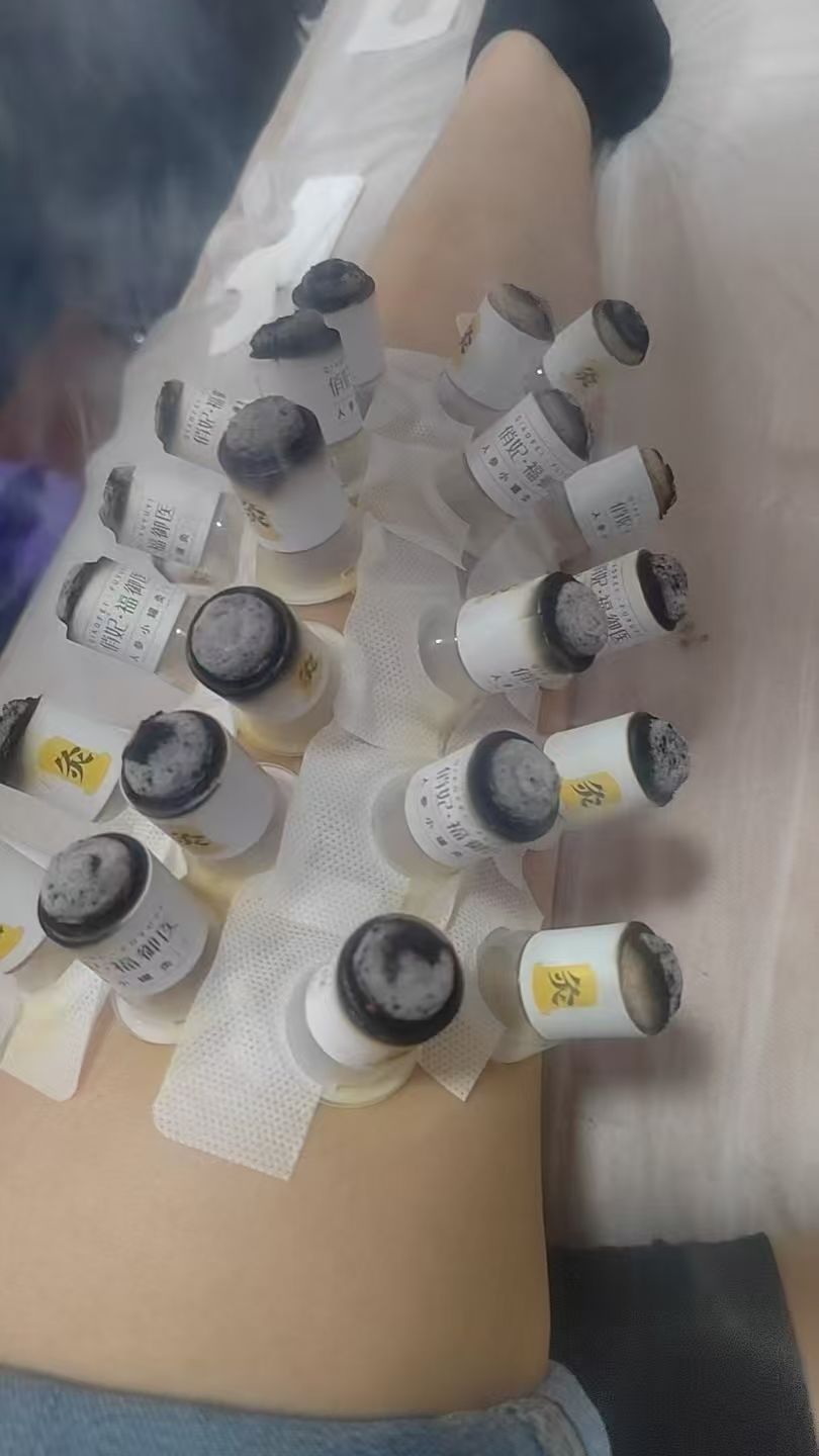 Cupping treatment lined across a guest's leg and hip area