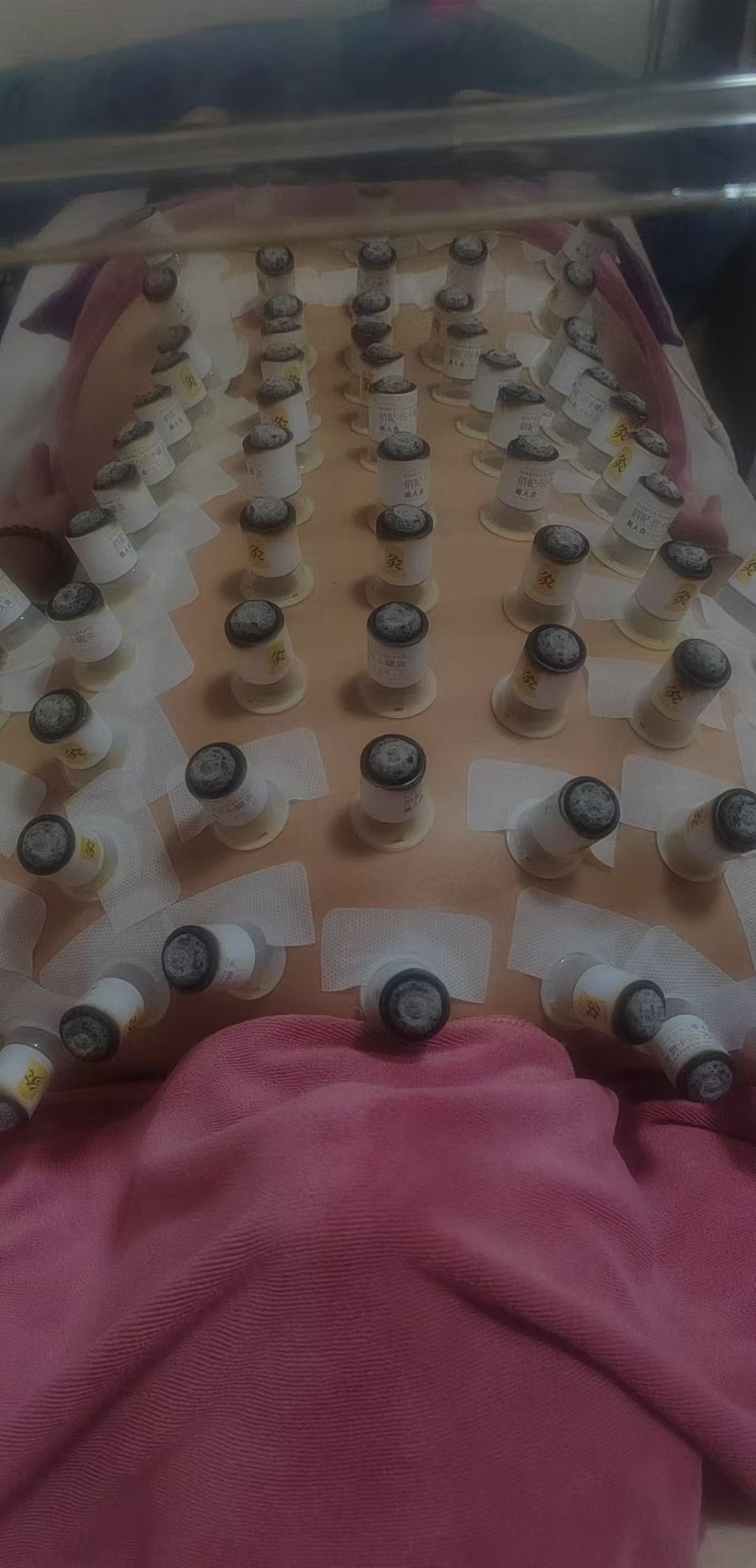 A full back treatment with many cups placed evenly across the body
