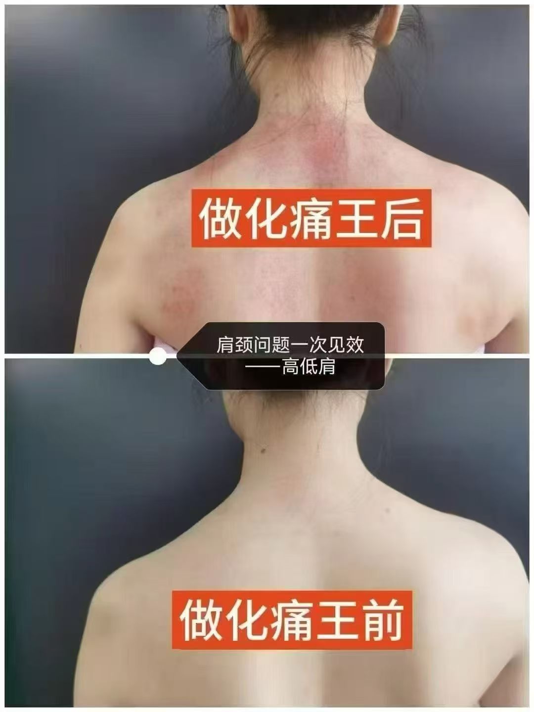 Before and after shoulder alignment result photo