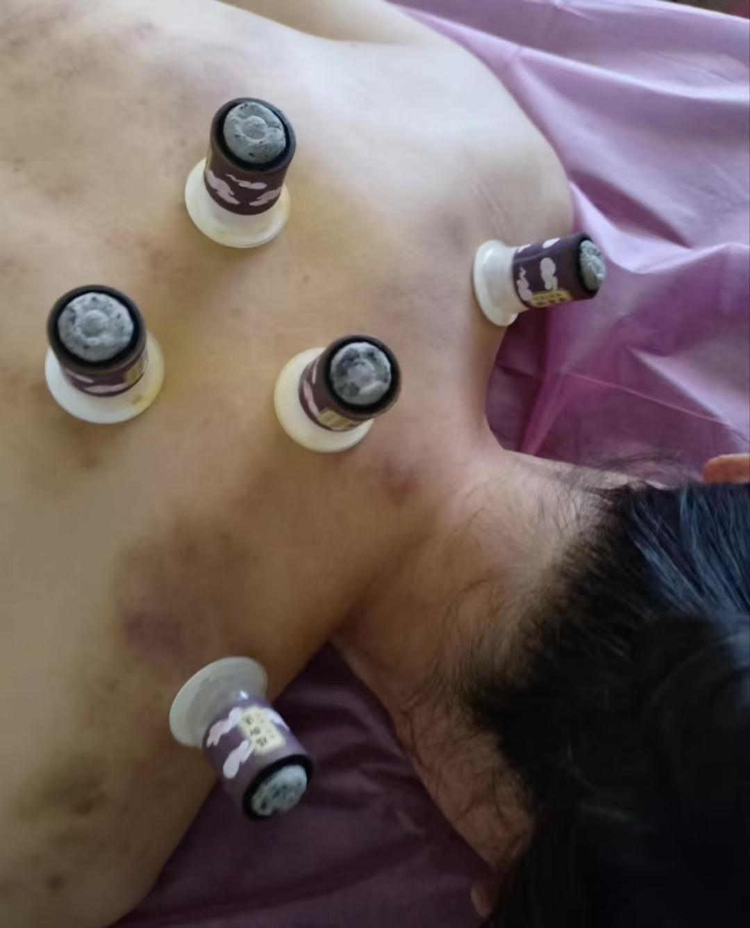 Therapeutic cups placed across a guest's back during treatment