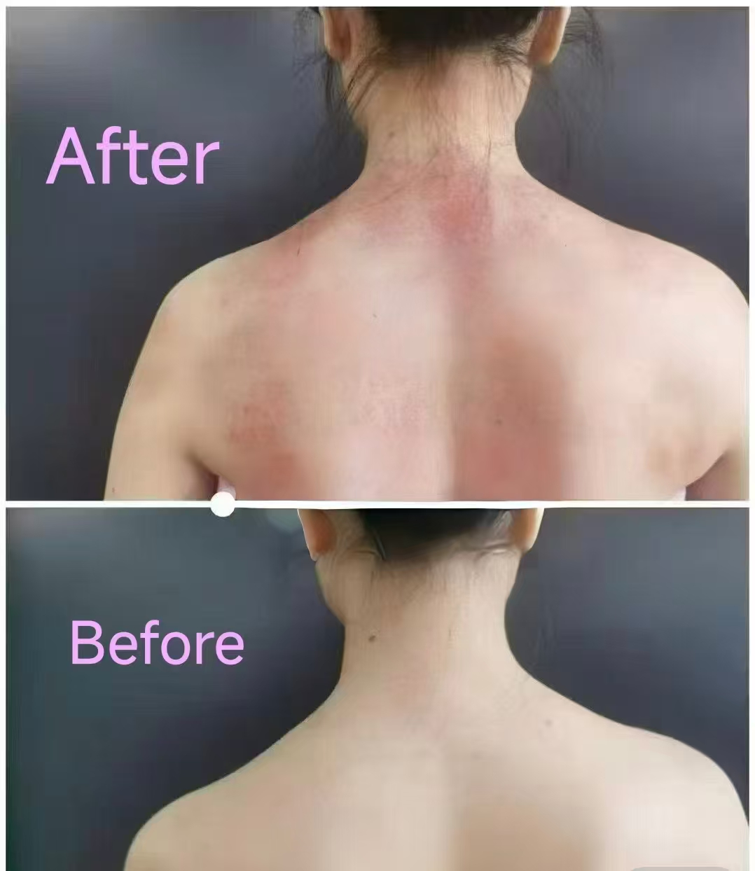 Before and after shoulder alignment treatment result